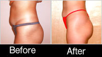 belly-before-after