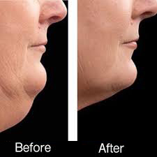lipotherapy