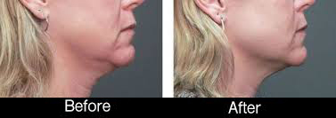 lipotheraphy